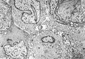 F,22y. | Pindborg tumor F,22y. | Pindborg tumor